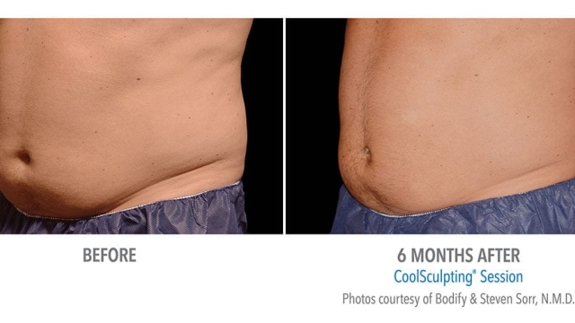 Frosting the Fat: Unveiling the Coolsculpting Revolution