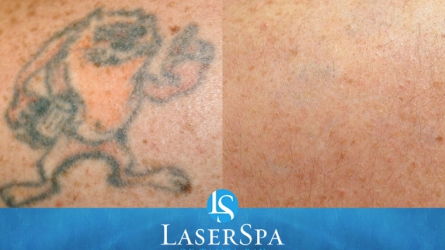 Tattoo Removal – What To Prepare For For Pain, Cost And Results