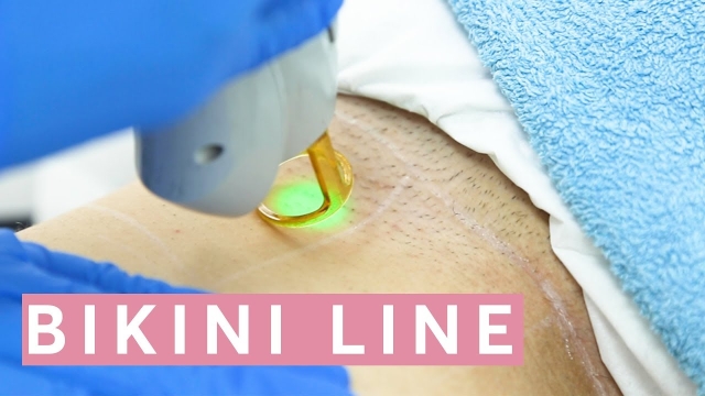 Beating the Burn: Unlocking the Magic of Laser Hair Removal