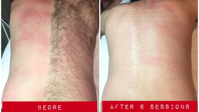 Say Goodbye to Unwanted Hair: The Definitive Guide to Laser Hair Removal